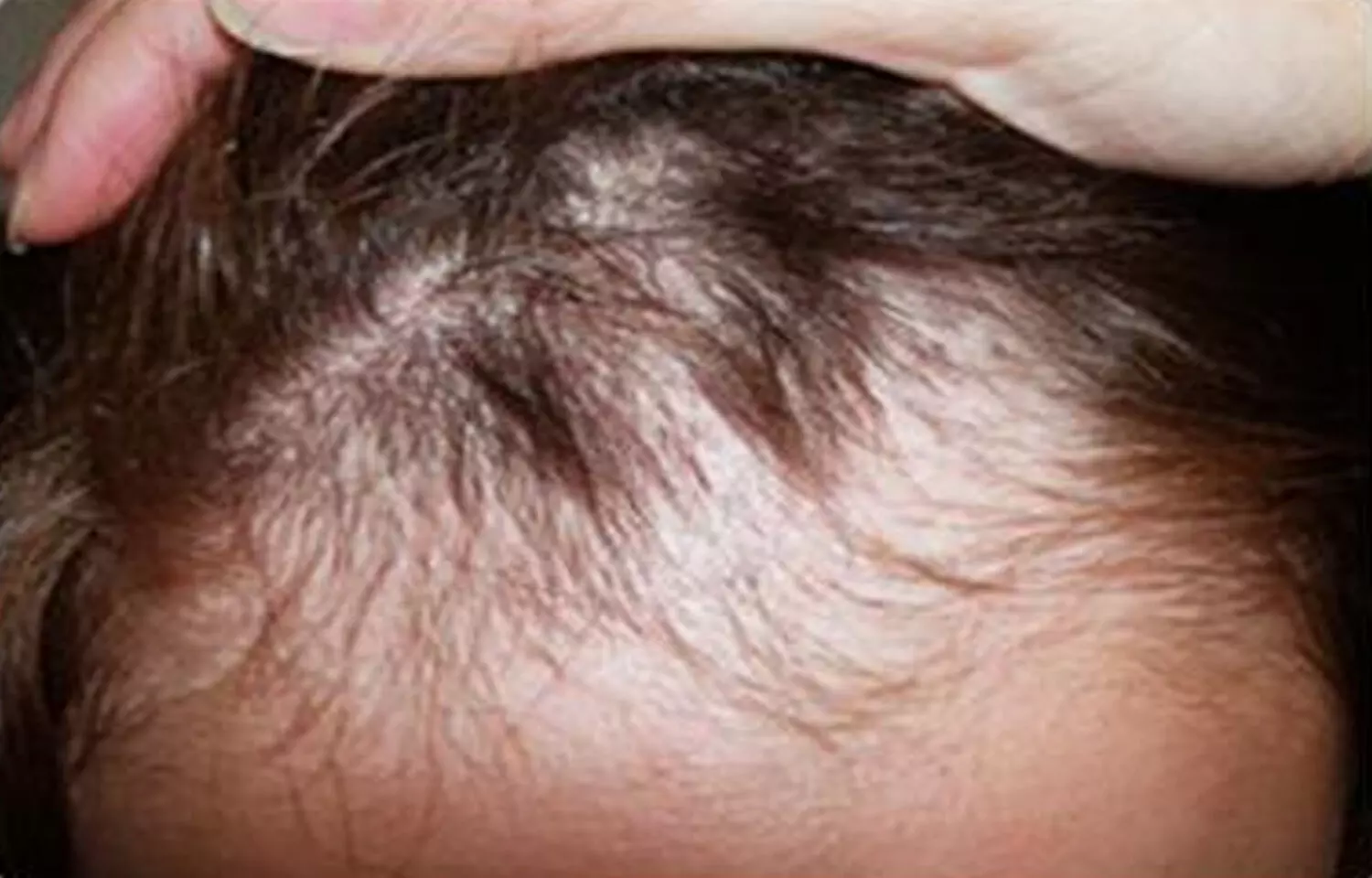 Oral minoxidil effective for treating hair loss in children and  adolescents: Study