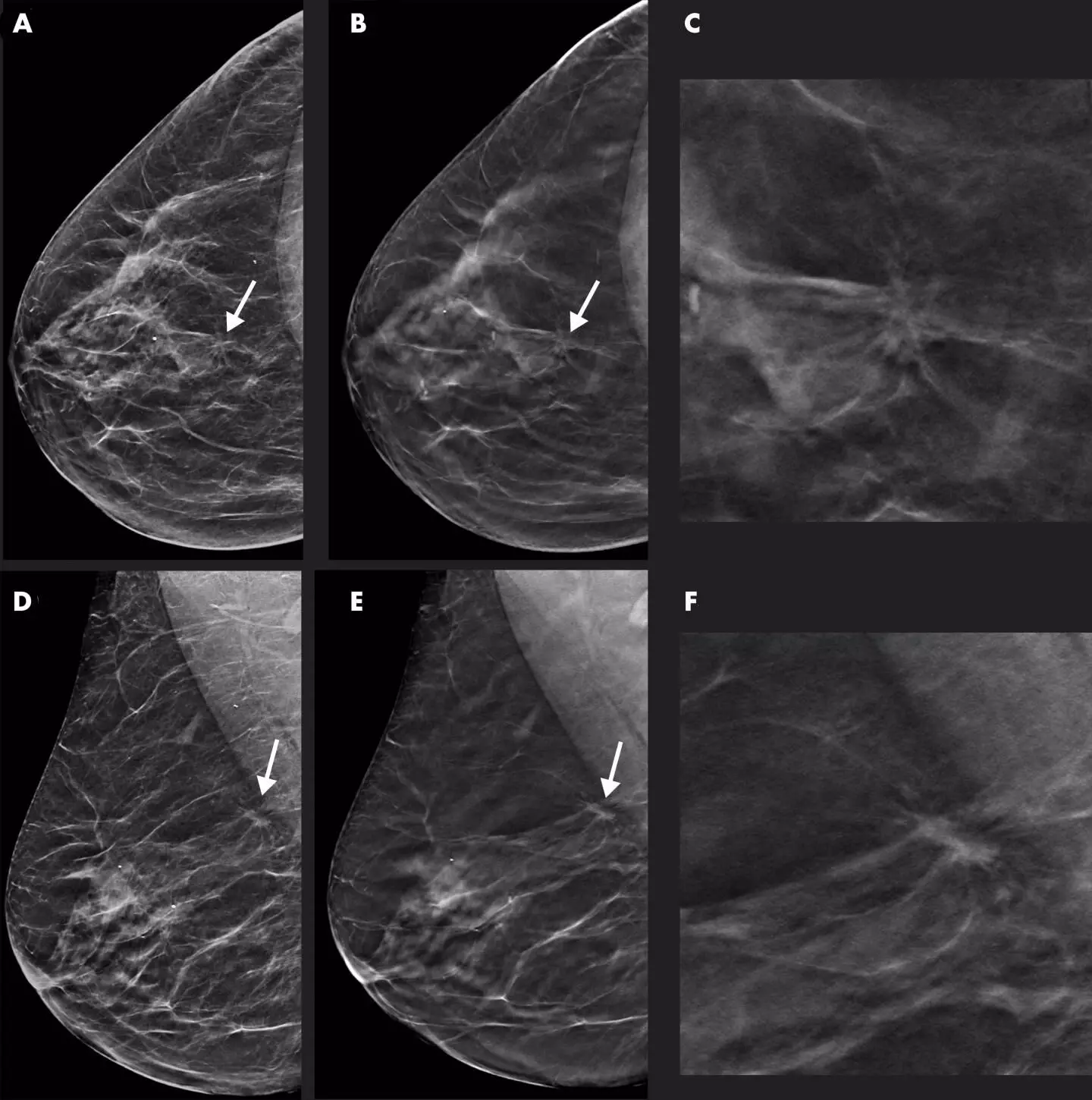 Digital breast tomosynthesis improves invasive cancer detection