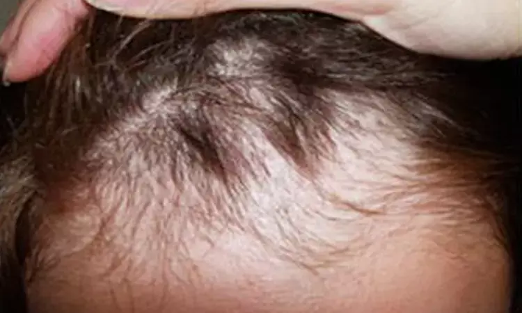 Tofacitinib may induce hair regrowth in over 80 percent children with alopecia: Study