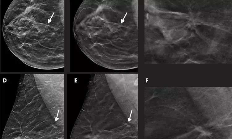 Mammographic breast density can predict risk of lymphedema: JAMA