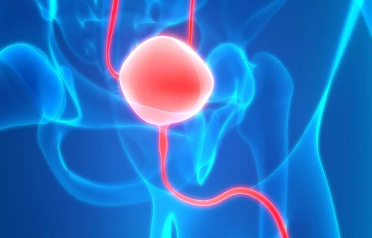 Nephroscopy versus cystoscopy for bladder stones significantly lowers operative time: Study