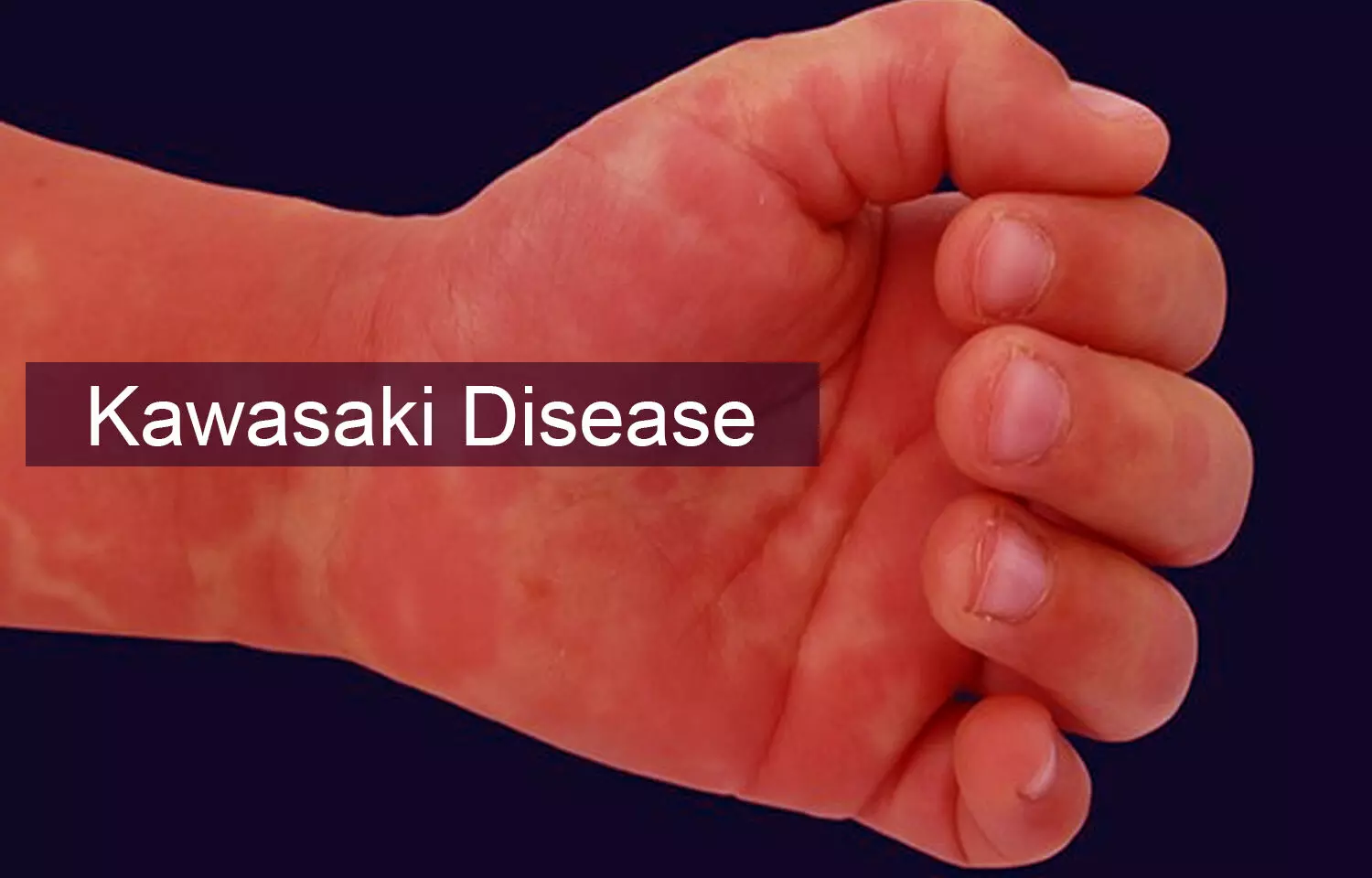 Children with Kawasaki Disease at higher risk for heart problems 10 years later
