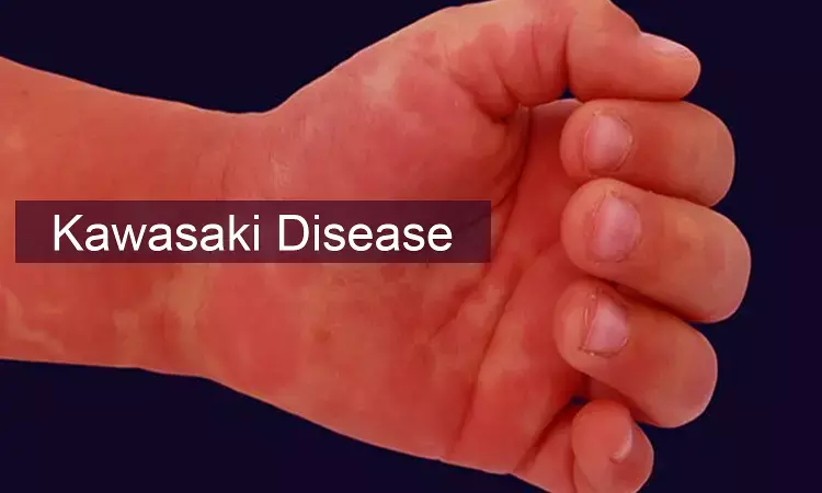 Children with Kawasaki Disease at higher risk for heart problems 10 years later