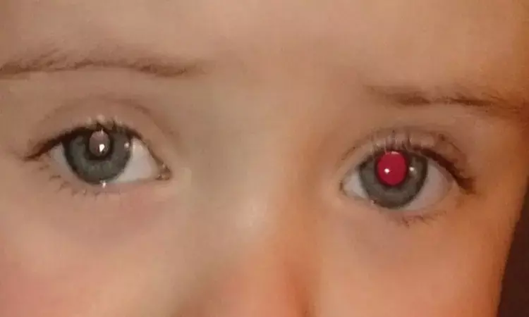 Abnormal red reflex indicates ocular disease in infants: JAMA