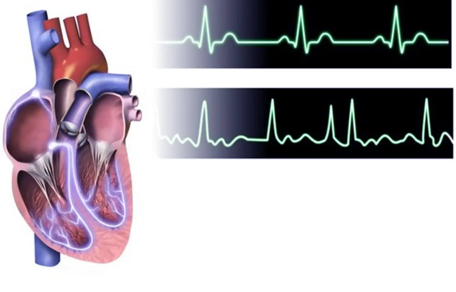 Mavacamten improves cardiac structure and function in HCM: Study