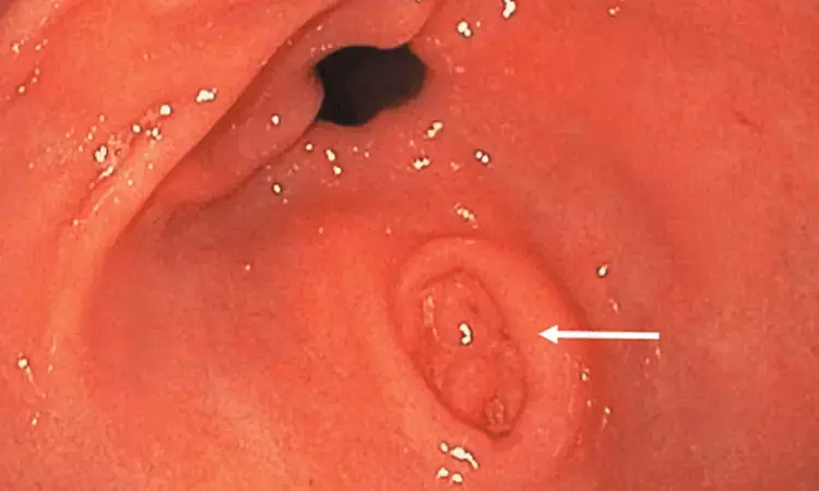 Rare case of incidental gastric diverticulum with chronic gastritis reported