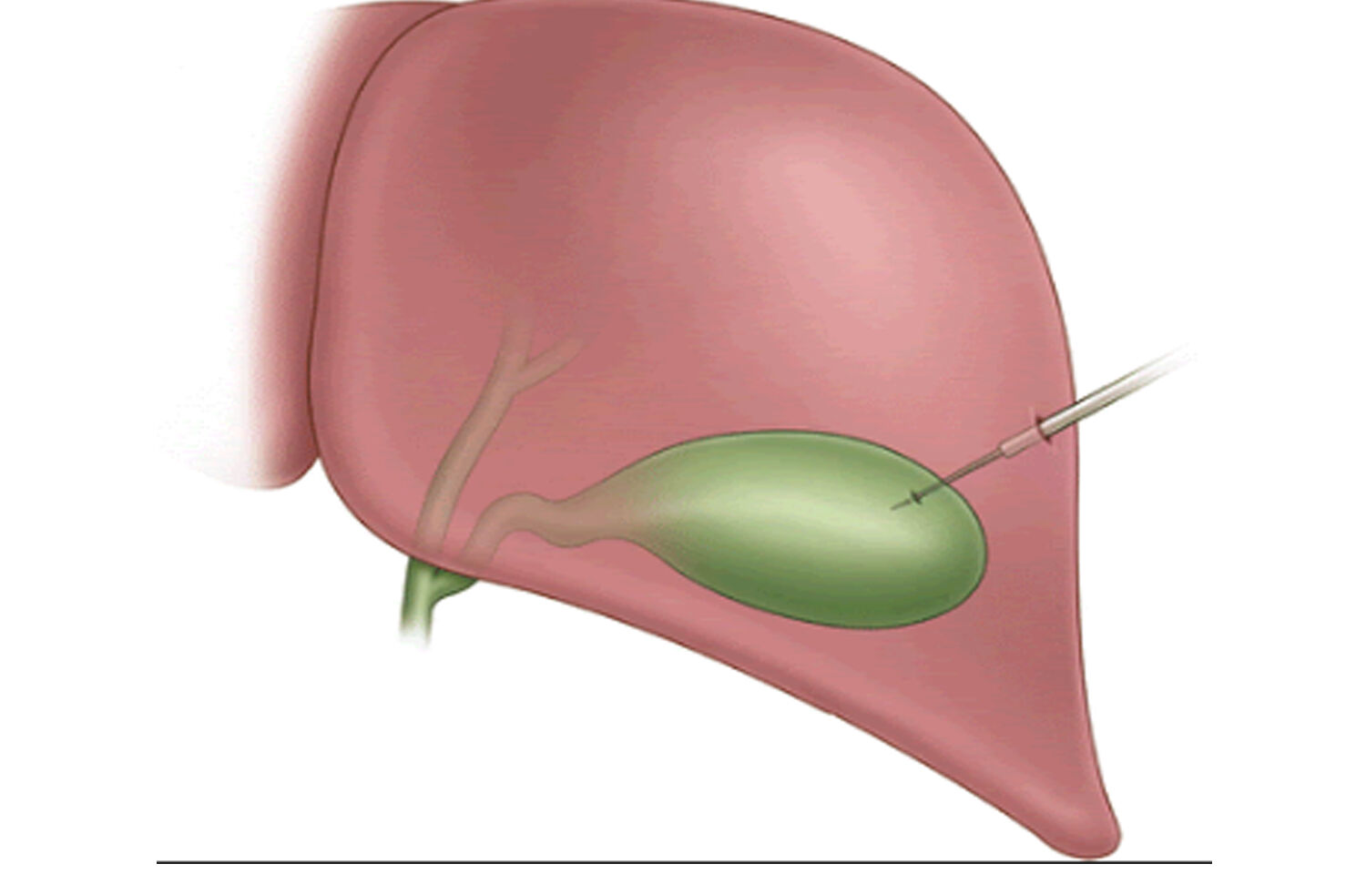 No benefit of PC over emergency cholecystectomy in Acute cholecystitis 