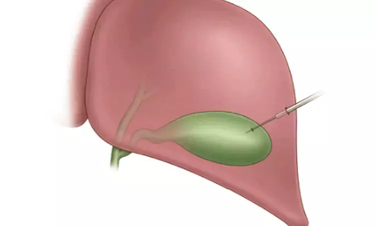 No benefit of PC over emergency cholecystectomy in Acute cholecystitis: Study