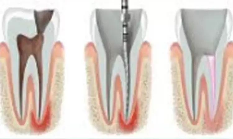 Photon-initiated photoacoustic streaming removes  bacteria in root canals with small diameter, taper