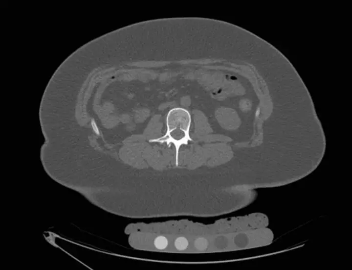 Ectopic bronchogenic cyst arising from diaphragm: Rare case reported