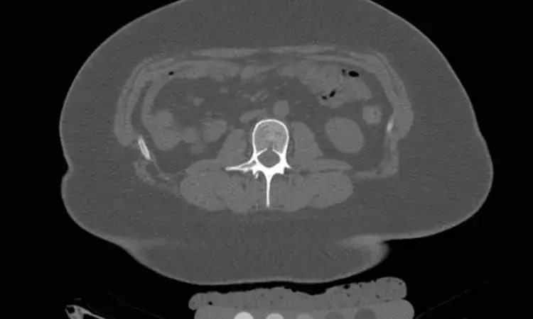 Ectopic bronchogenic cyst arising from diaphragm: Rare case reported
