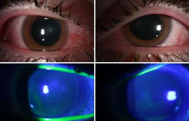 Use of Ultraviolet lamps to contain COVID-19 spread tied to cornea damage