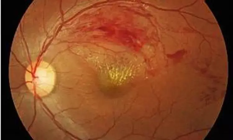 Female hormone therapy not linked to retinal vascular occlusion; JAMA Ophthalmology