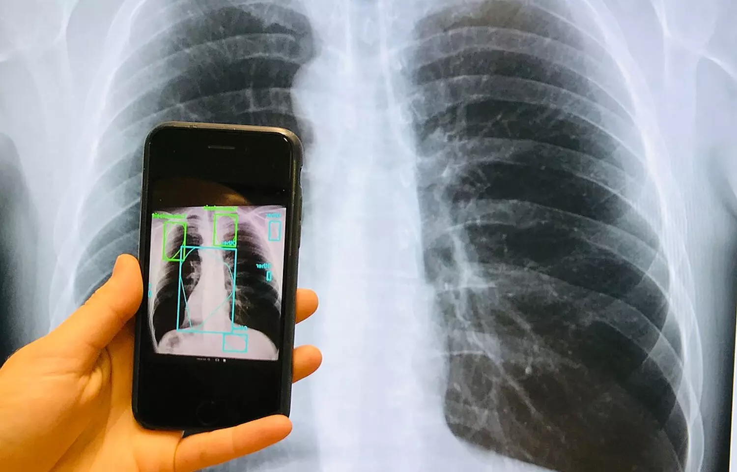 TB can be detected on smartphone using new model: Study