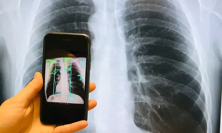 TB can be detected on smartphone using new model: Study