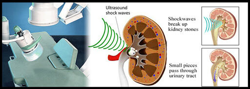 Ultrasound-guided ESWL effectively treats renal and ureteral stones in children: Study