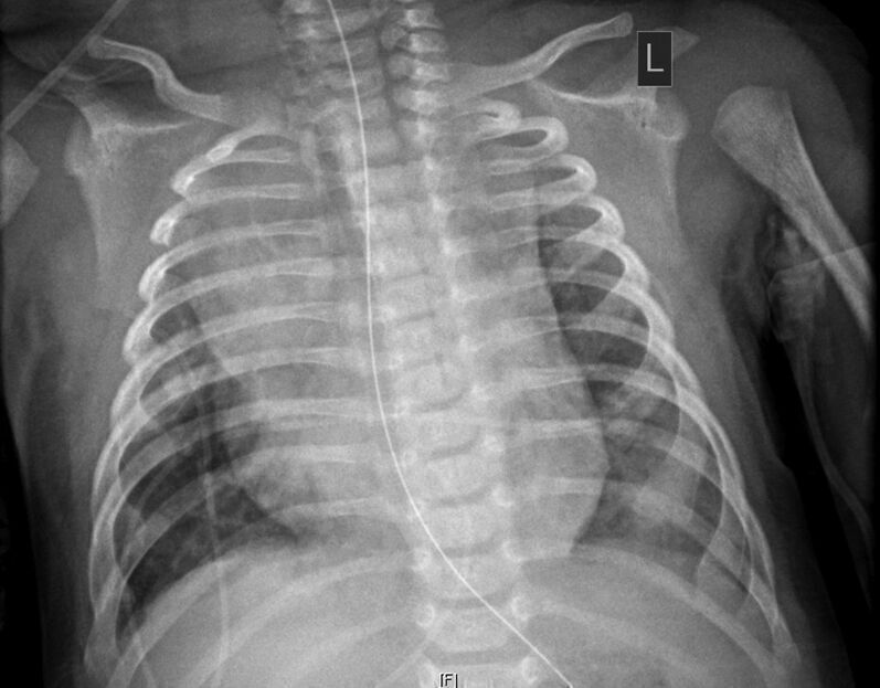 Heart failure reported in 2-month-old with COVID-19: JACC: Case Reports