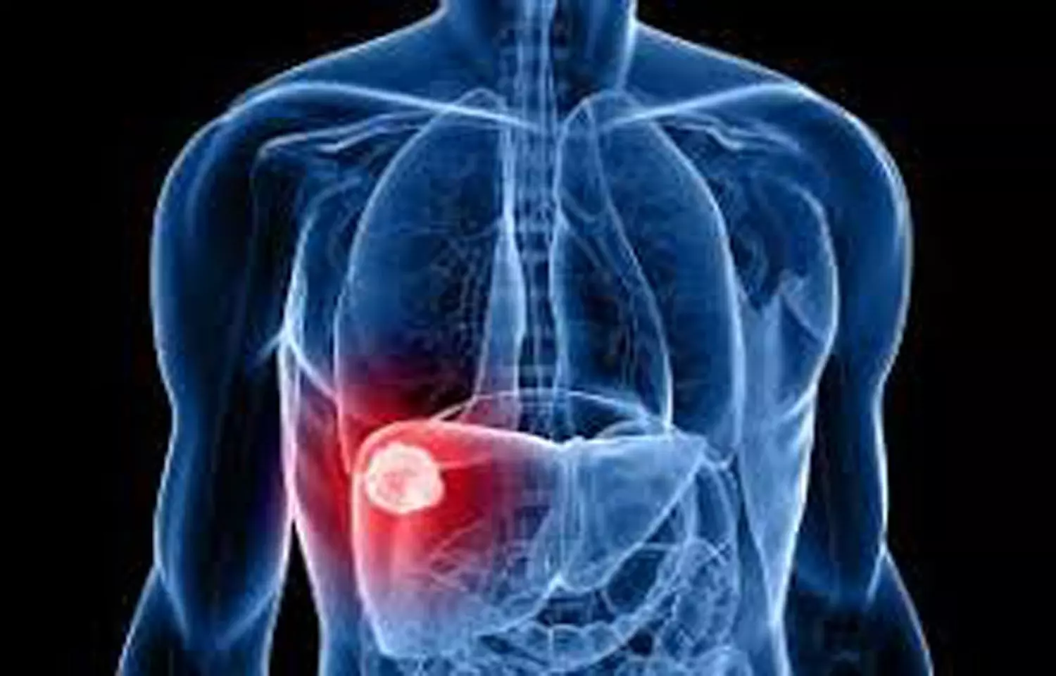 Shorter intervals of ultrasound screening helps in early detection of liver cancer: JAMA