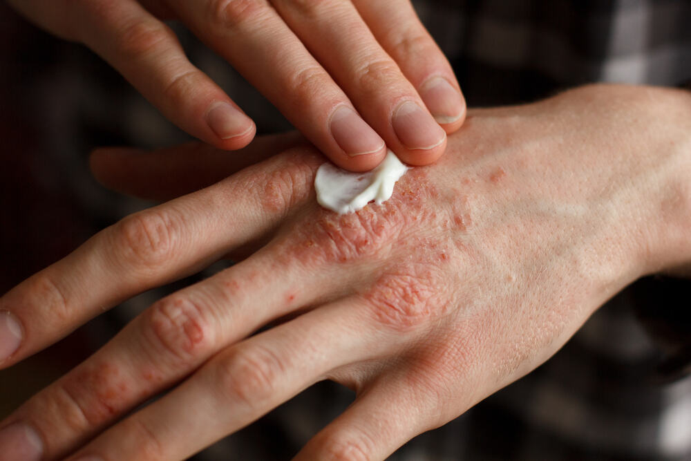 Benvitimod cream a new topical treatment for plaque psoriasis