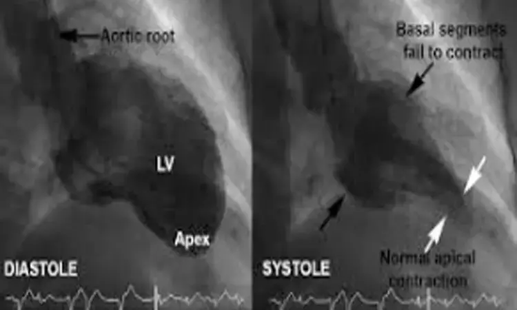 Case of reverse takotsubo Cardiomyopathy caused by cryptogenic stroke- A report