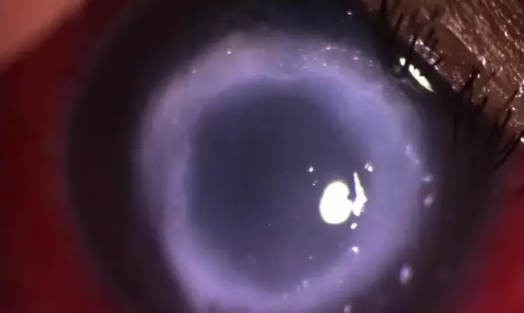 Ocular infection by P. glucanolyticus causing Keratitis and Corneal Perforation: Case report
