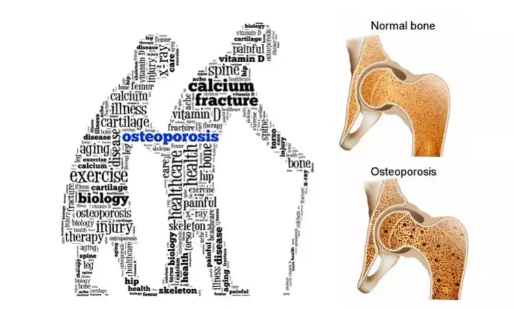 Zoledronic acid therapy for osteoporosis may raise risk of incident AF: Study