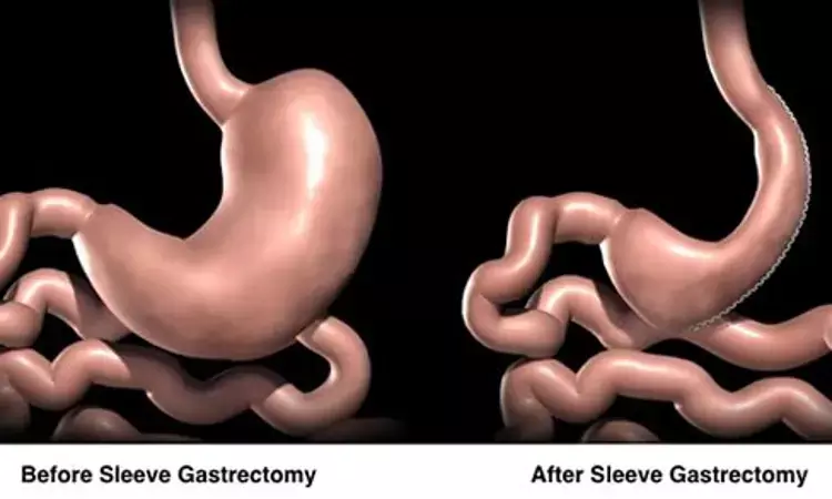 Laparoscopic sleeve gastrectomy shows long-term positive outcomes in obese teenagers