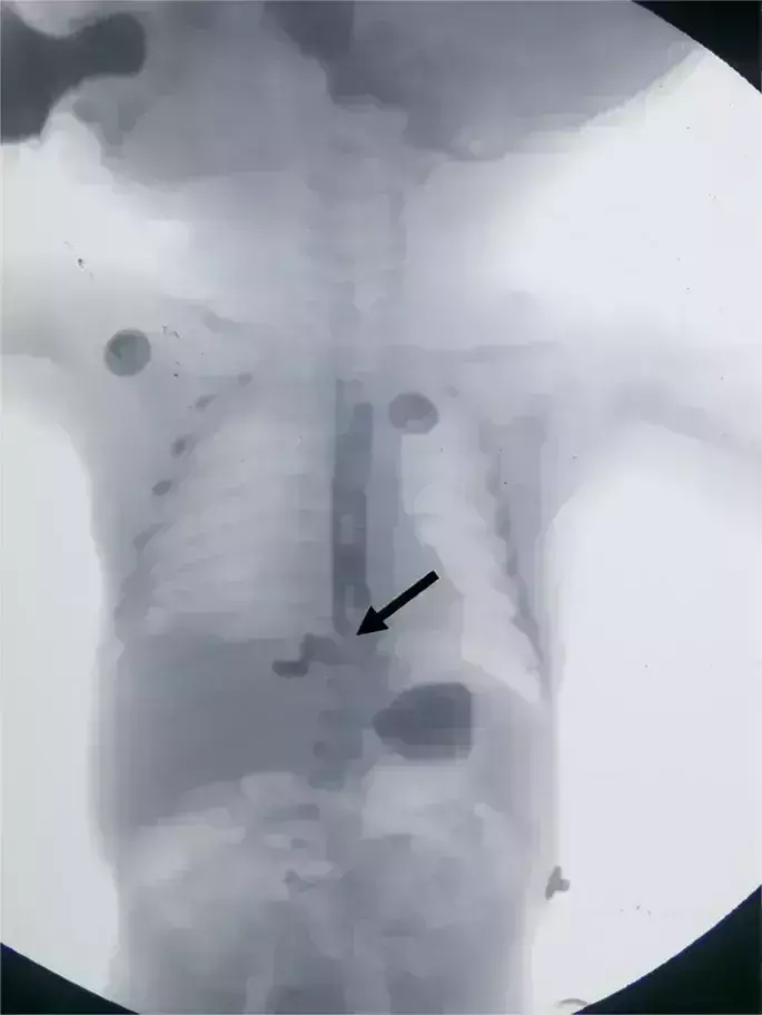Rare case of neonatal Idiopathic esophageal perforation reported