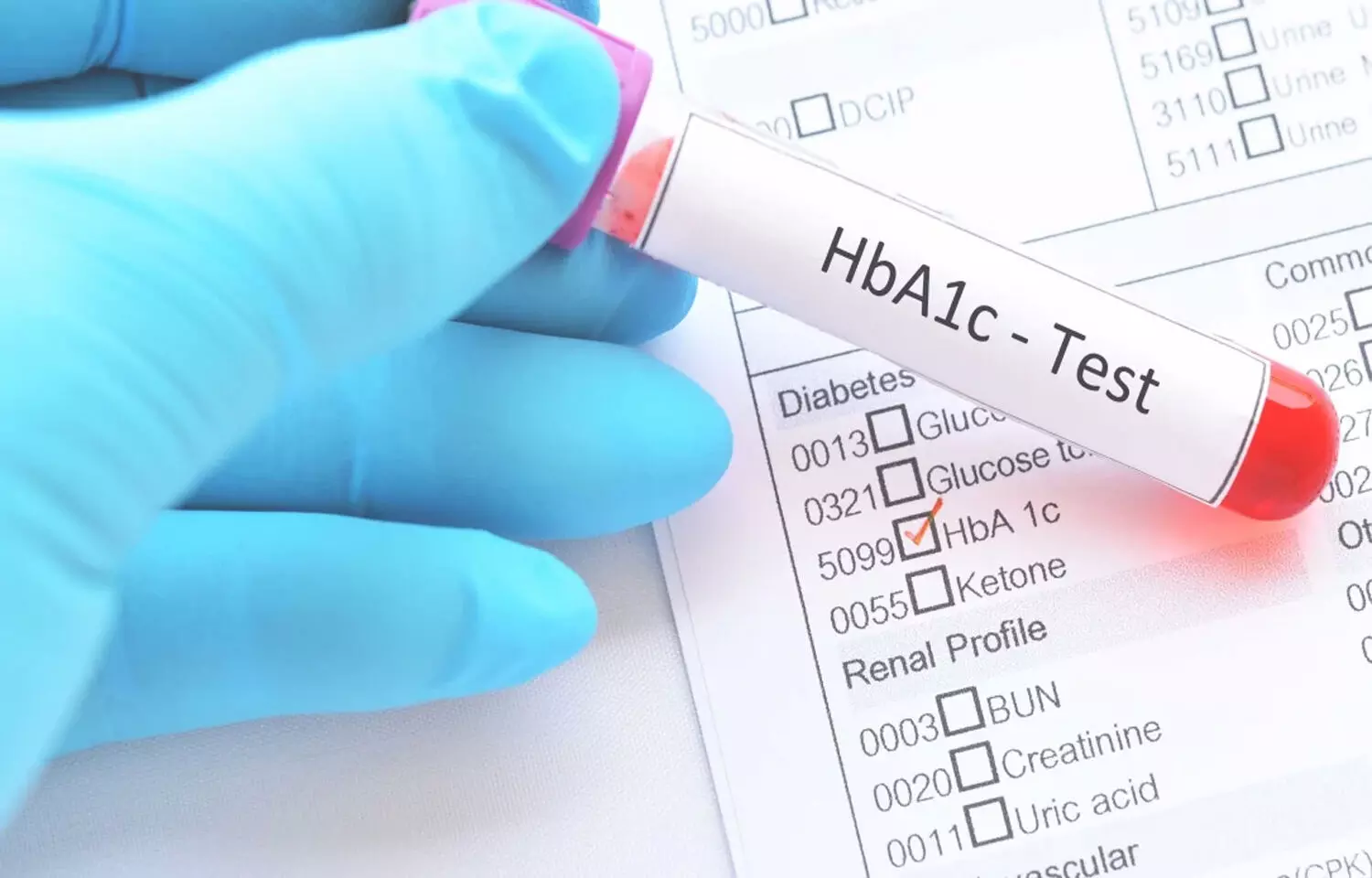 Treat anemia first, before using HbA1C for accurate estimation of blood sugar