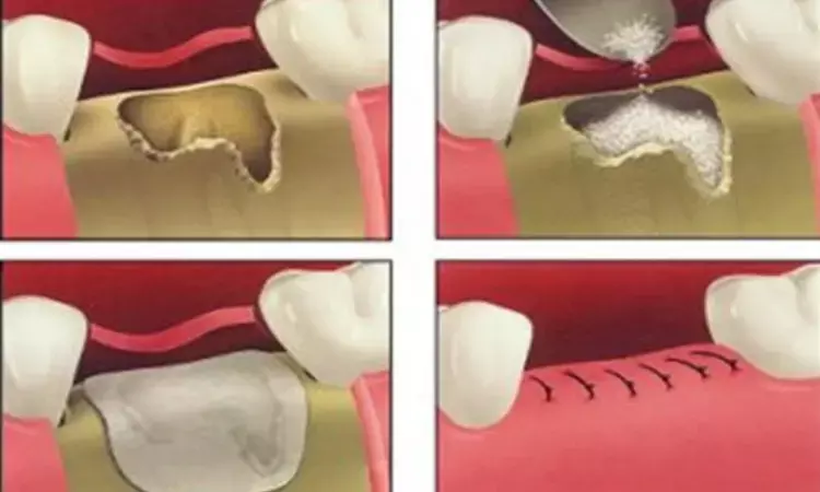 Ridge preservation may reduce ridge resorption in sockets of periodontally compromised teeth