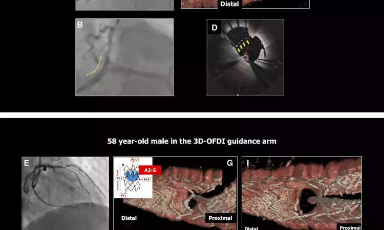 Online 3D-OFDI-guided PCI bests angiography-guided PCI in bifurcation lesions
