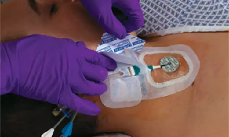 Tips to prevent puncturing subclavian artery during IJV cannulation