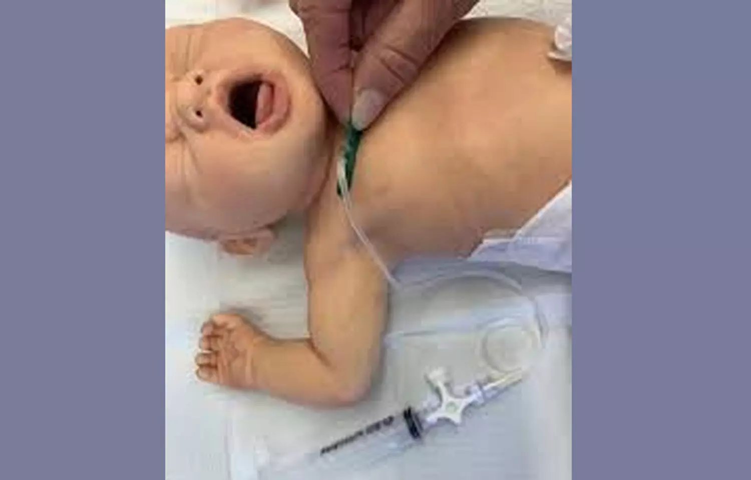 An early IV-to-oral antibiotic switch equivalent to Full IV course in Neonates: LANCET