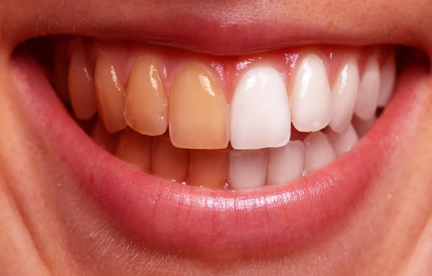 Different phases of  calcium aluminate cement linked to tooth discoloration: Study