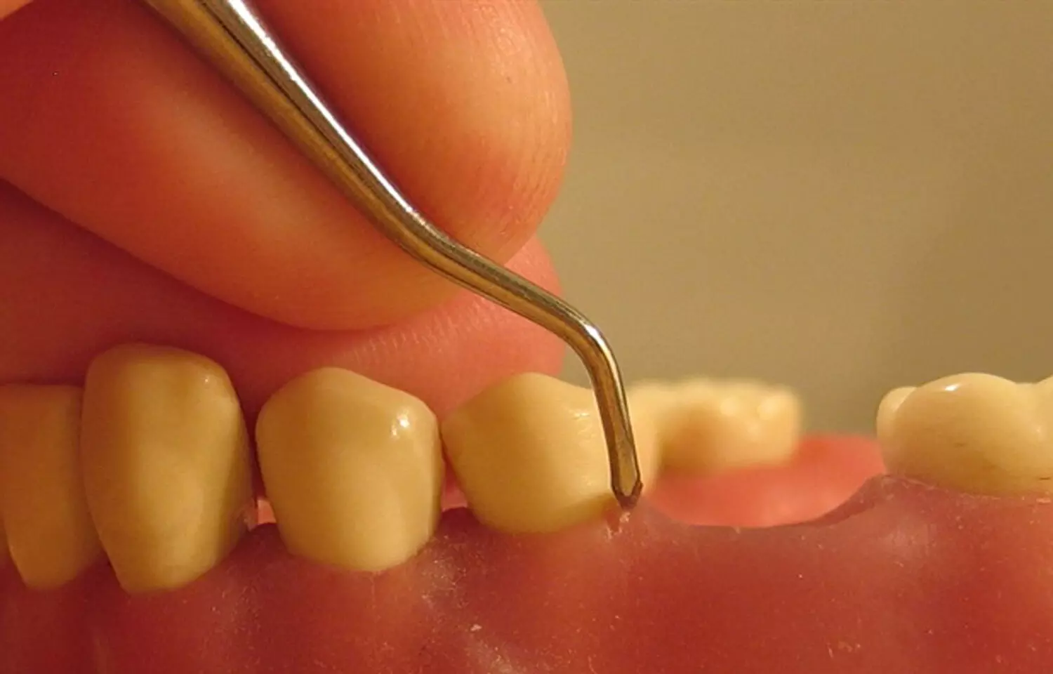 Molecules derived from omega-3 can regenerate inflamed periodontal tissue