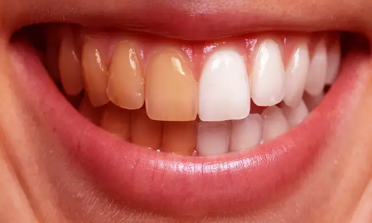 Bleaching with 37.5% hydrogen peroxide lowers intensity of tooth sensitivity