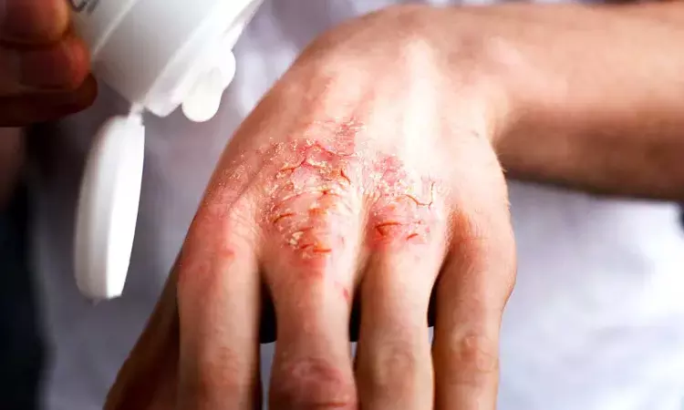 Ruxolitinib shows promise in managing atopic dermatitis: Study