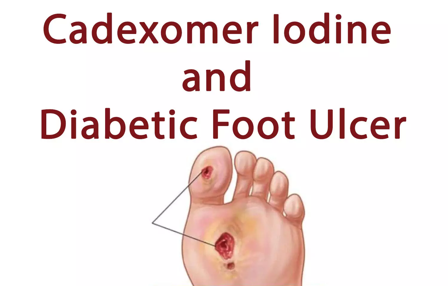 Successful treatment of diabetic foot ulcer during COVID-19 lockdown using Cadexomer Iodine: Case report