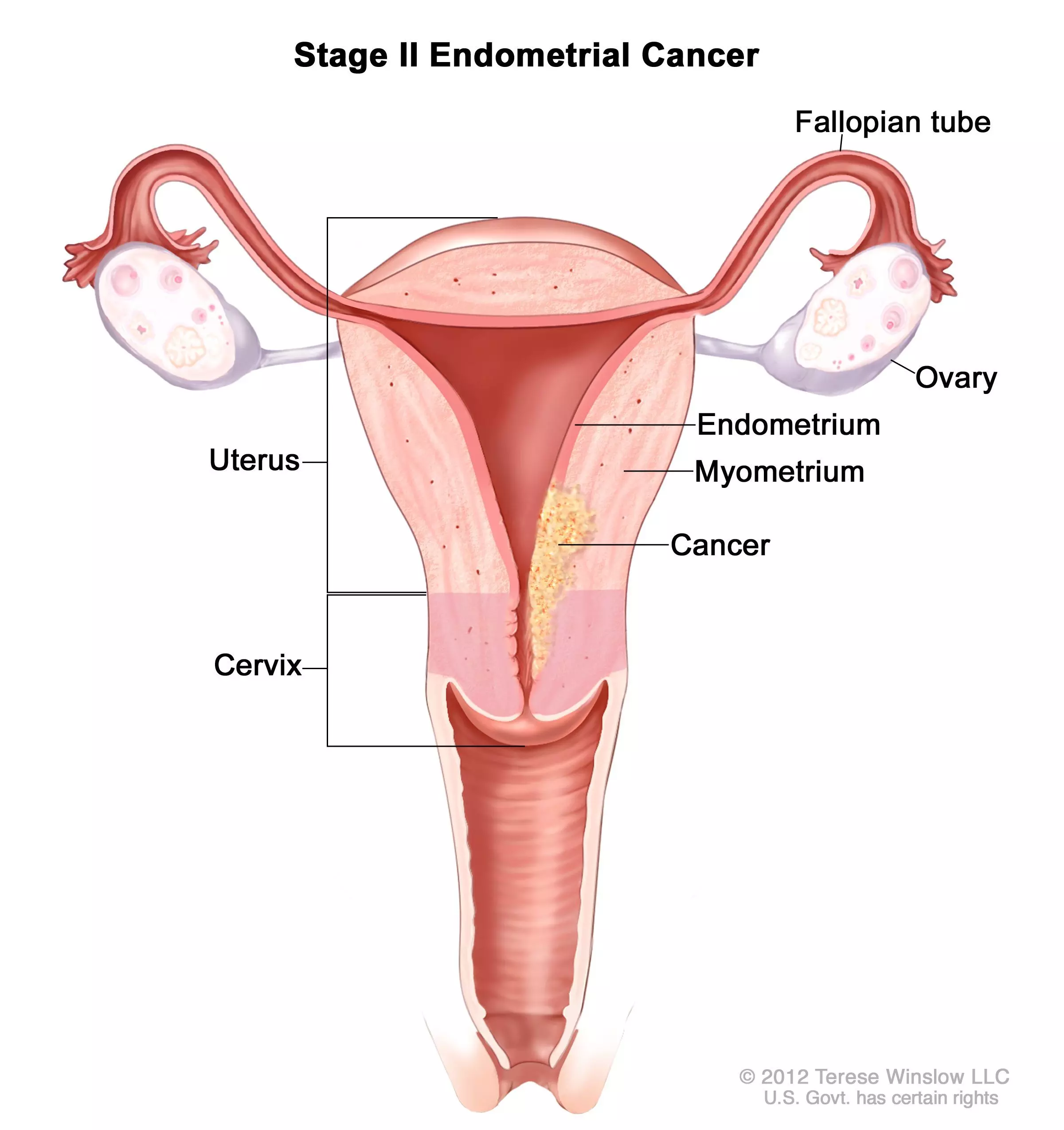 Is Hysteroscopy Safe for diagnosing Type 2 Endometrial Cancer?