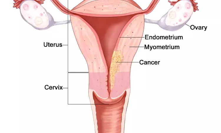 Women with endometrial cancer at higher risk for cardiovascular diseases: Study