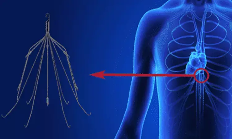 Use of inferior vena cava filters for treatment of VTE: SIR Guideline