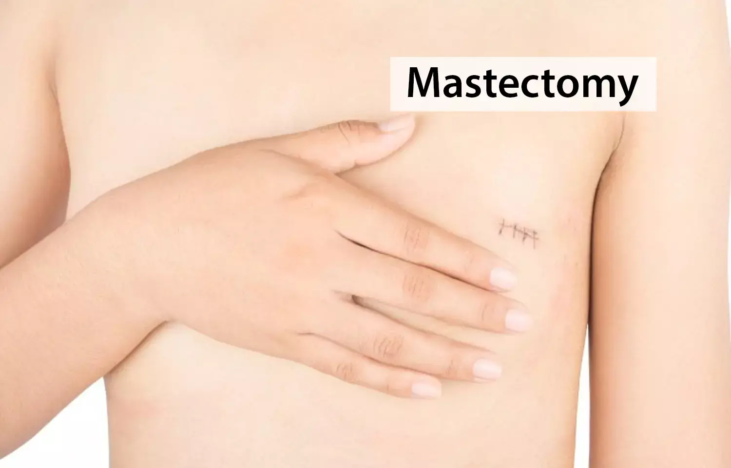 More women forgoing reconstruction after mastectomy, claims study