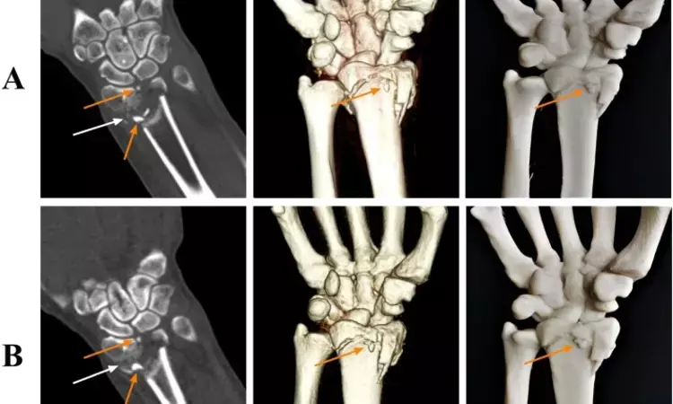 Ultra-low-dose of CT in 3D printing models good enough to diagnose wrist fractures