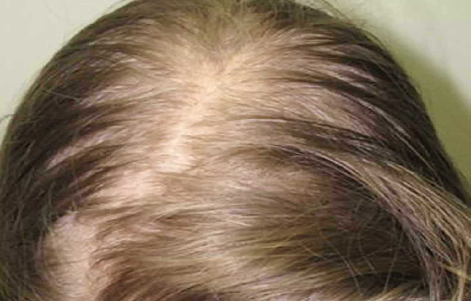Scalp neuropathy associated with androgenetic alopecia: JAAD study
