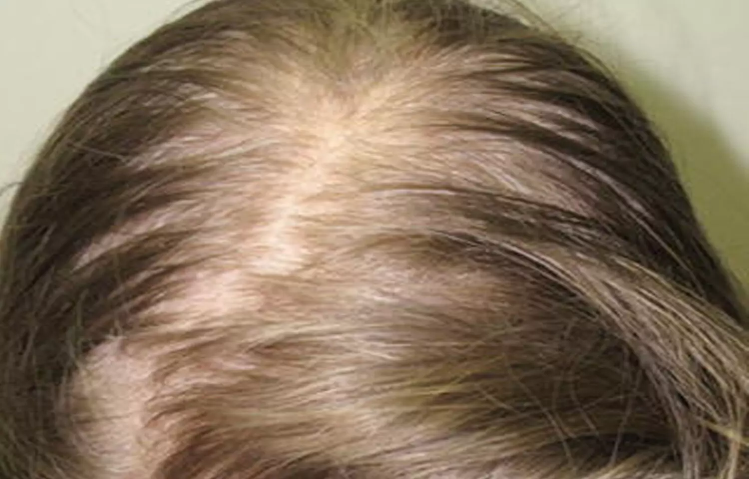 An Old Medicine Remedies Hair Loss for Pennies a Day Doctors Say  The New  York Times