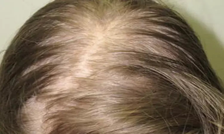 Oral minoxidil and spironolactone combo effective in alopecia in females: Study