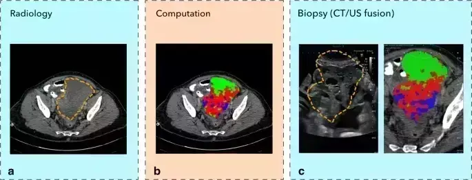 CT/Ultrasound Fusion, a novel sampling technique of ovarian biopsy