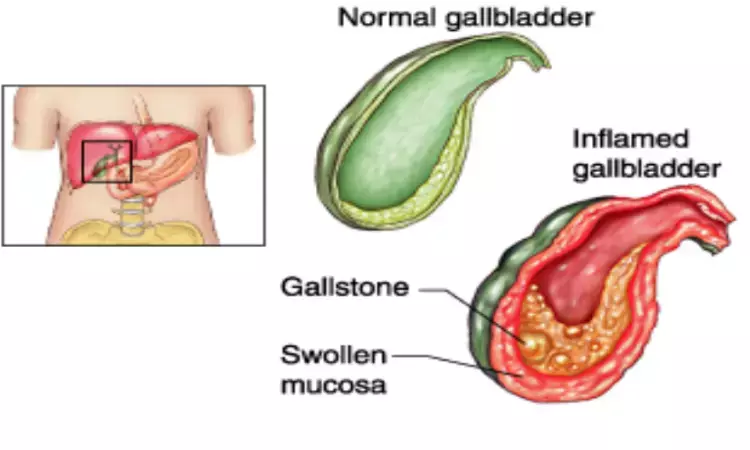 Diagnosis and treatment of acute calculus cholecystitis: WSES 2020 Guideline
