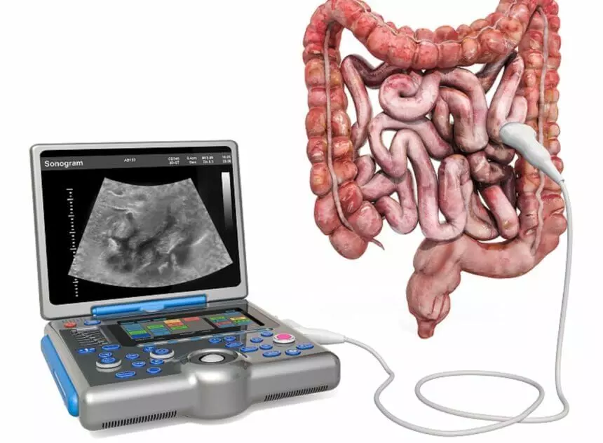 Gastrointestinal ultrasound helps predict Ulcerative colitis in advance