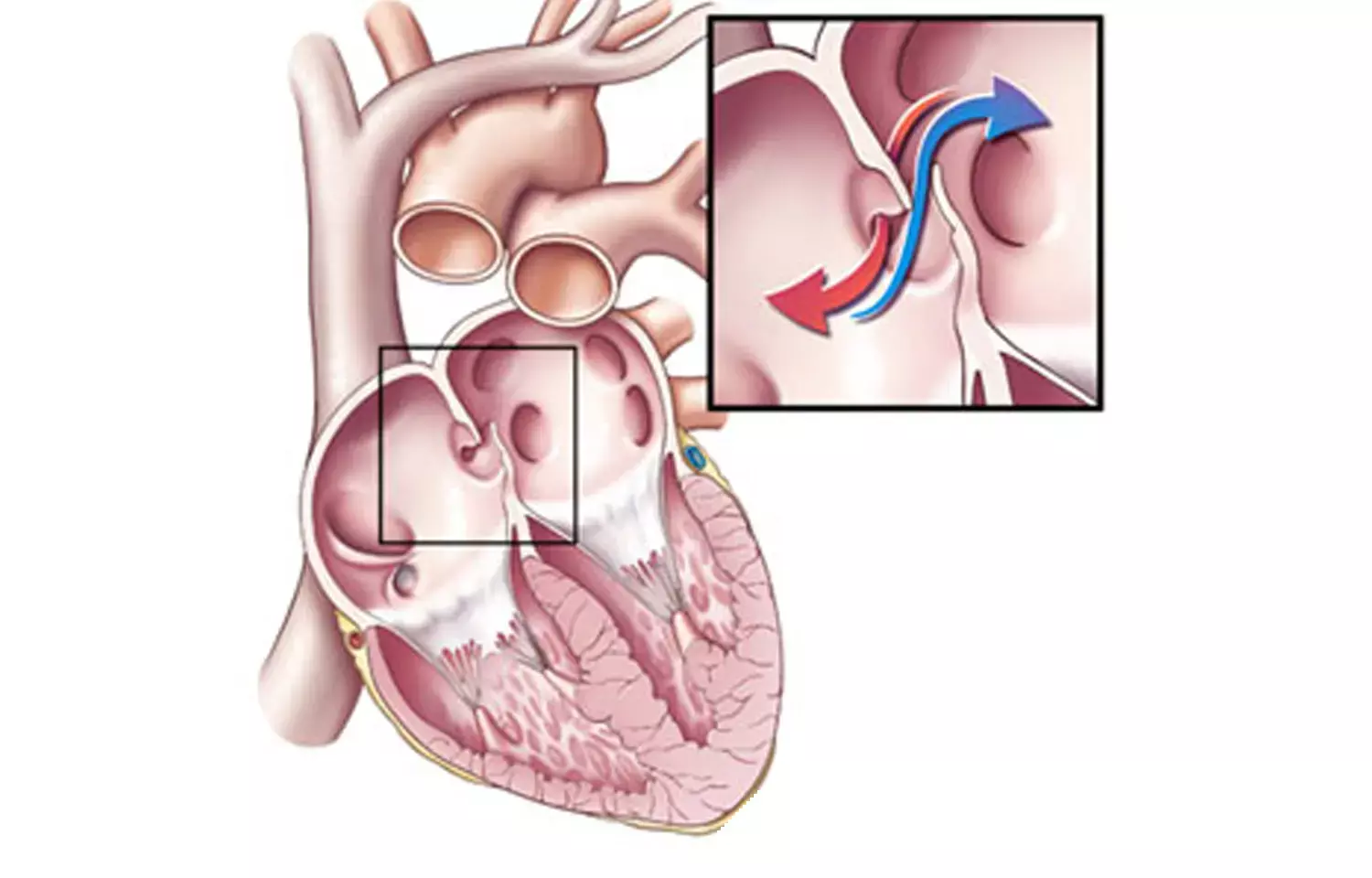 Management of patent foramen ovale in patients with stroke history: AAN Guideline